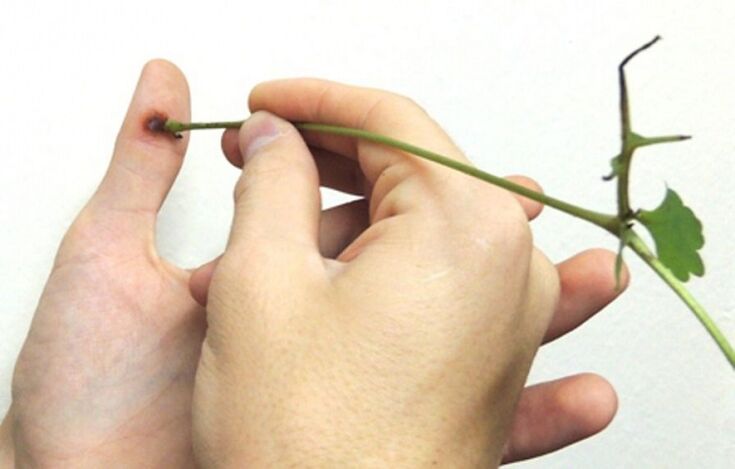 Rimozione di una verruca sul dito con succo di erbe di celidonia